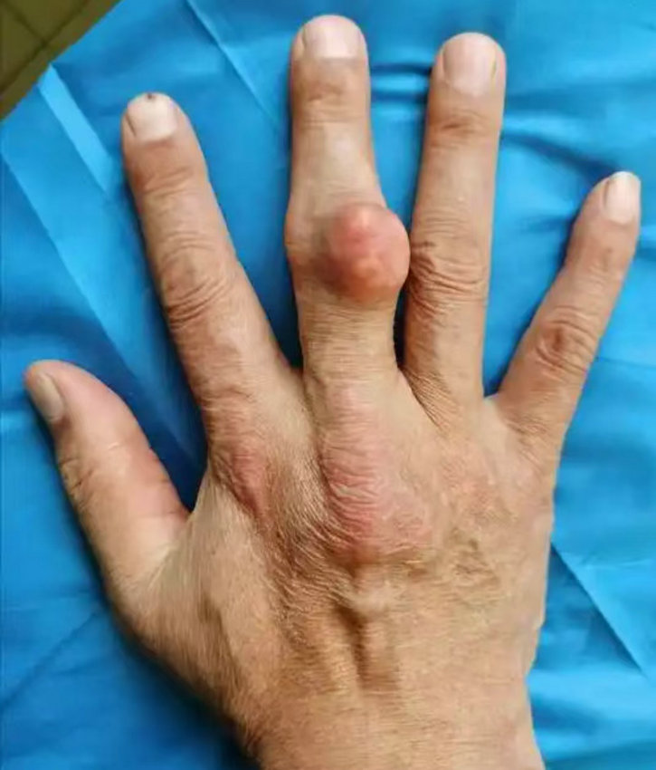 老年痛风患者如何健康生活？