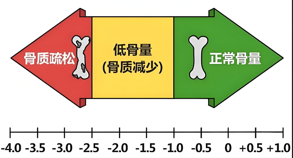 你真的需要测骨密度吗？这些检测方式不可信