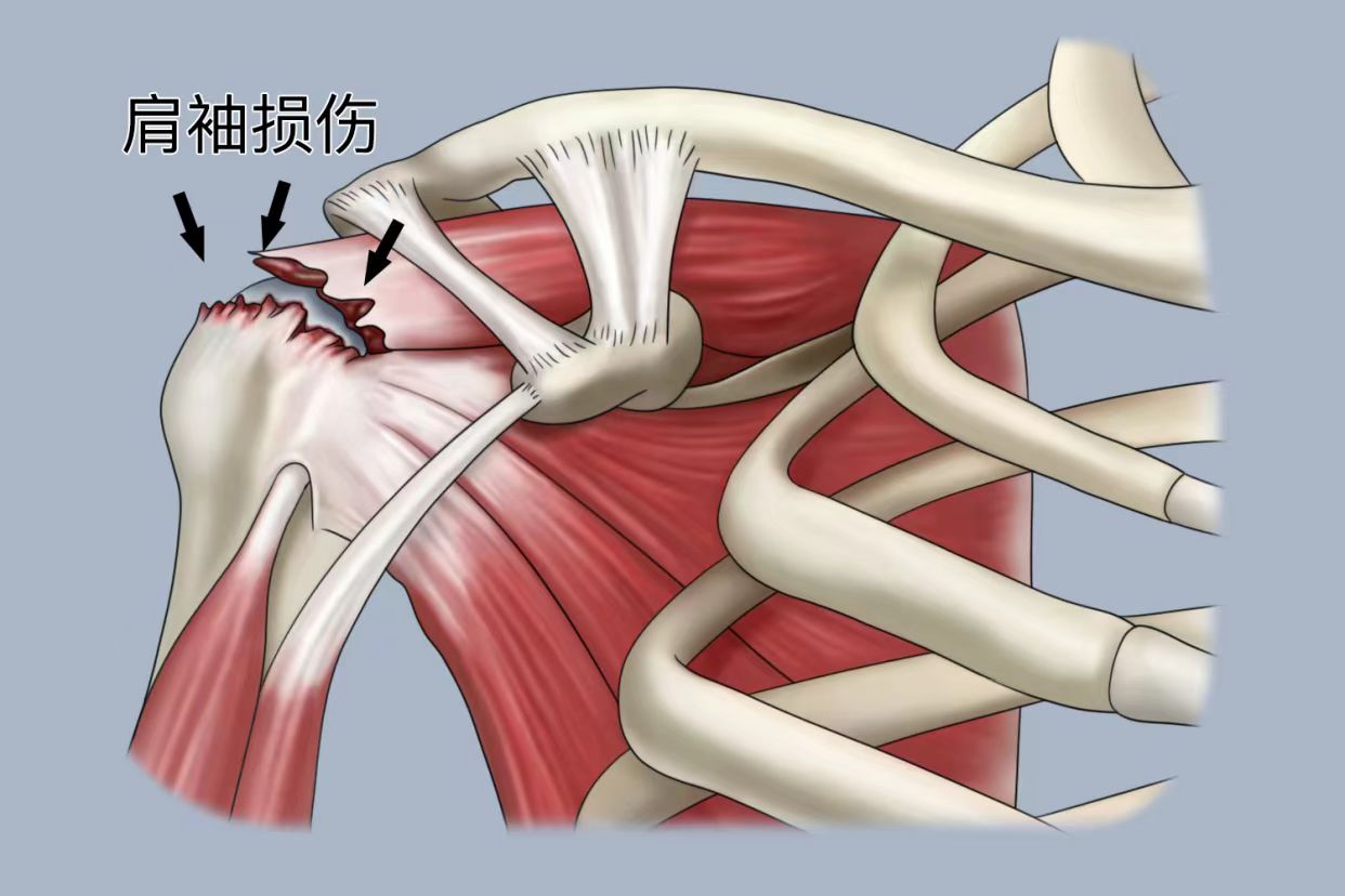 关节咔咔作响是病吗？
