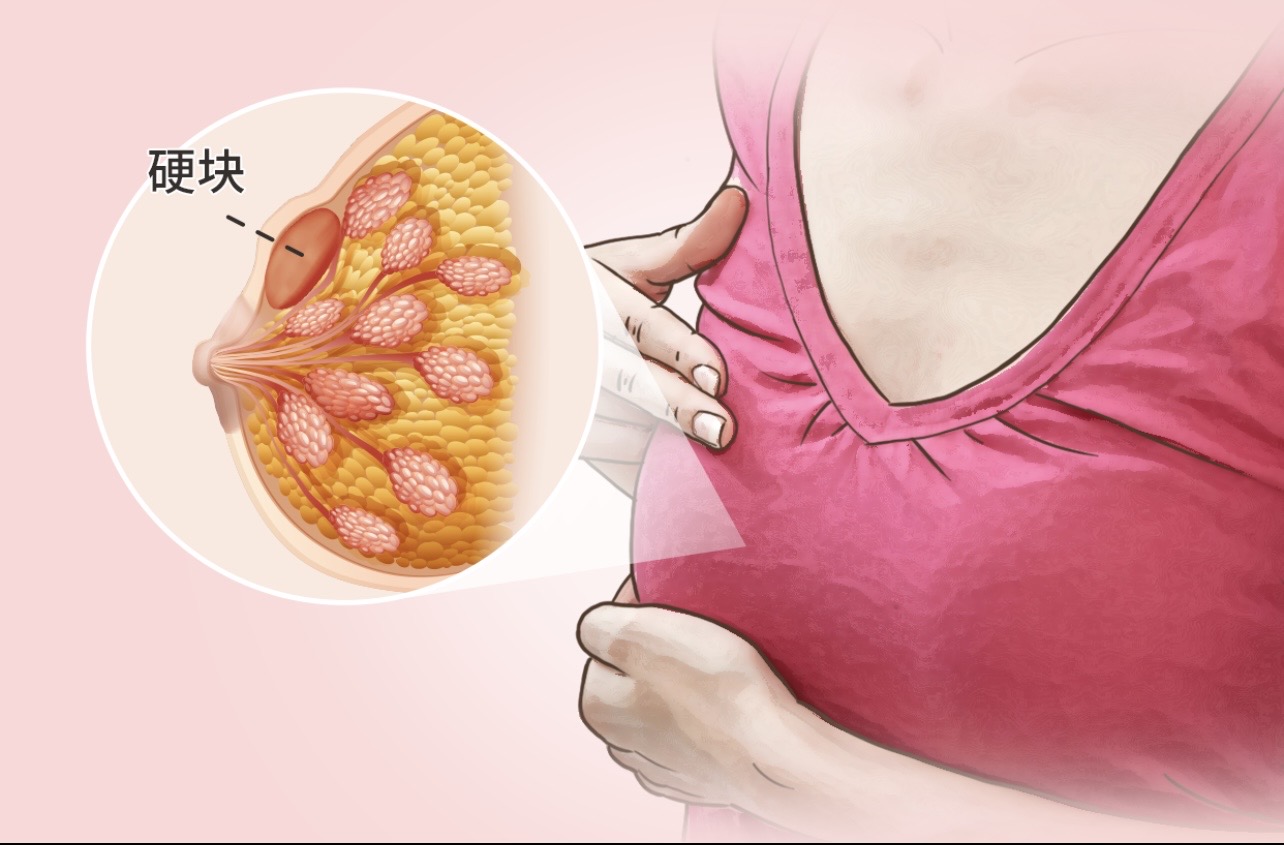 乳腺包块别慌：揭开它的“真面目”