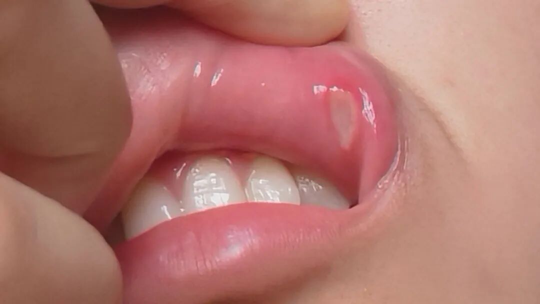 口腔溃疡老不好别怪上火！这3个生活习惯才是关键