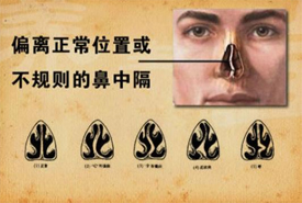 鼻中隔偏曲科普知识