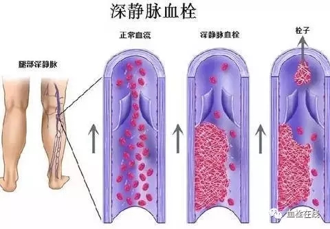 【科普】腿肿，警惕下肢深静脉血栓形成！