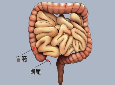 小小阑尾，不可忽视-阑尾炎